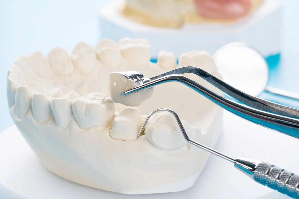 Best Crown Bridge Treatment in Salt Lake