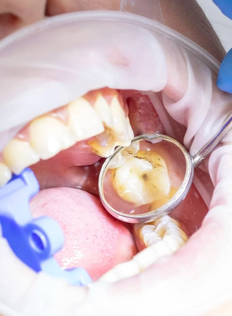 Best Dental Fillings in Salt Lake