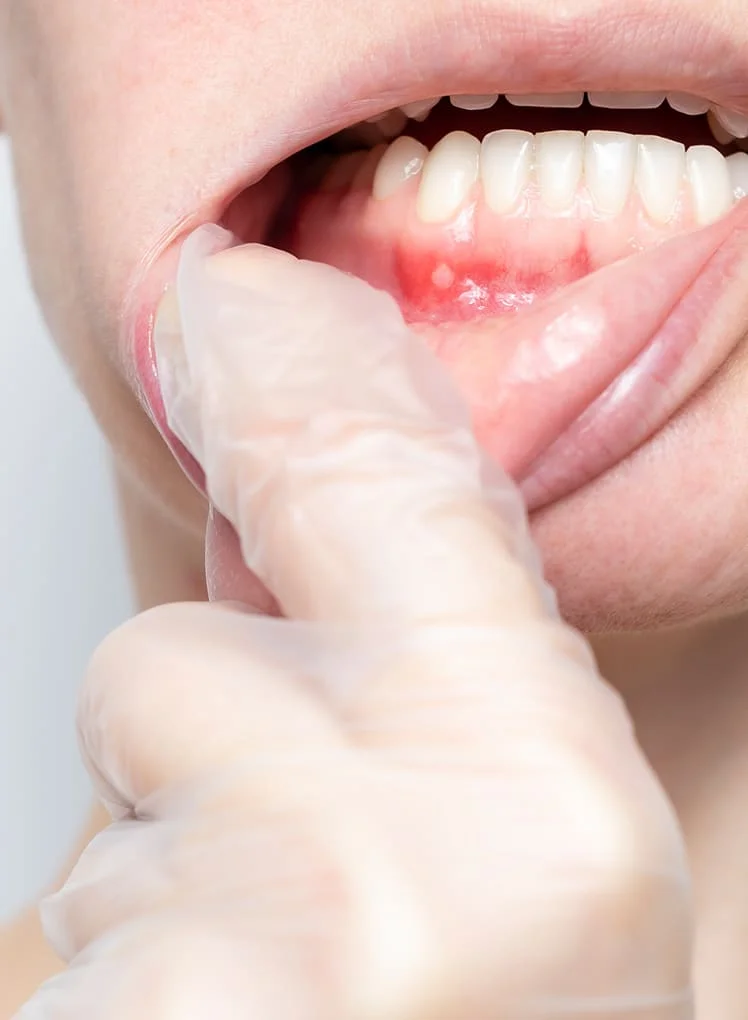 Best Gum Treatment in Salt Lake