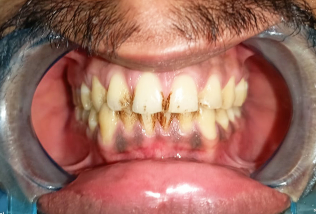 before after 1 before after 1