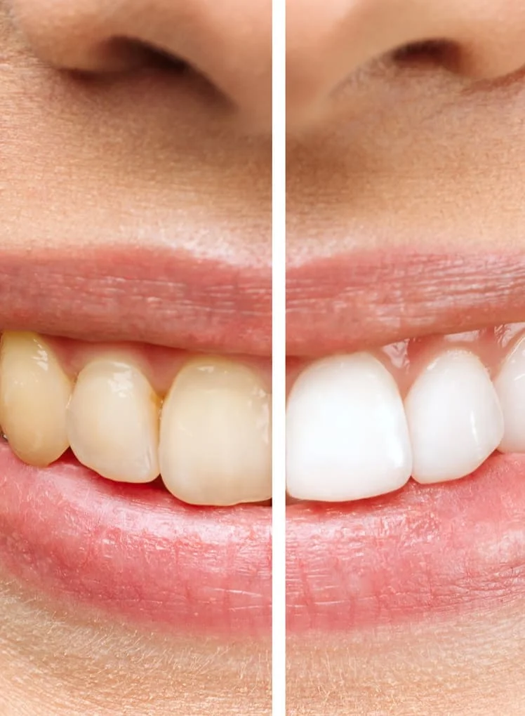 Teeth Whitening Treatment
