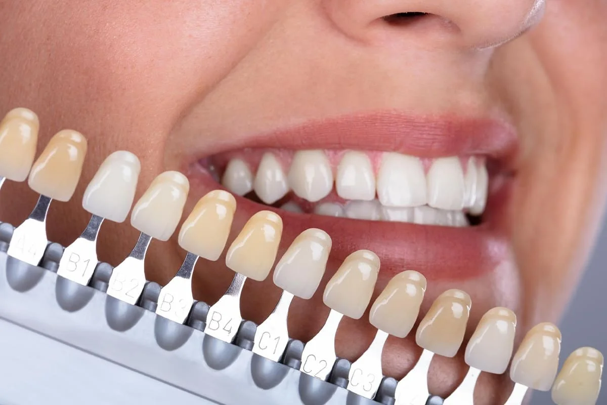 Teeth Whitening Treatment